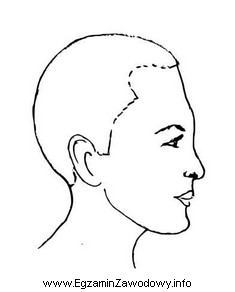 Którą deformację głowy klientki przedstawiono na rysunku schematycznym?
