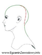 Na schemacie czerwoną przerywaną linią jest oznaczona deformacja głowy 