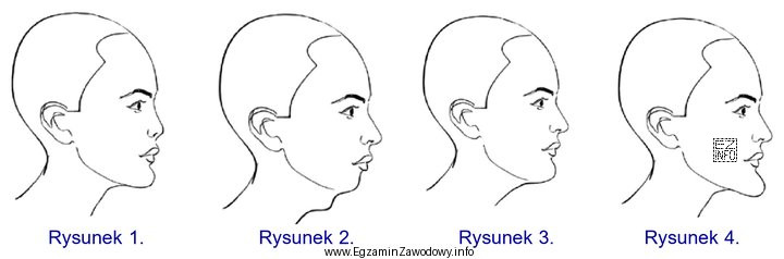 Na którym rysunku schematycznym przedstawiono wysuniętą brodę?
