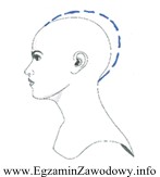 Którą deformację głowy oznaczono na rysunku linią przerywaną?