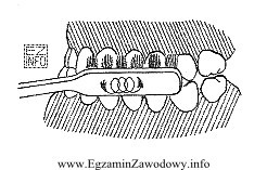 Przedstawiona na rysunku metoda oczyszczania uzębienia zalecana jest