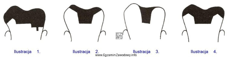 Która ilustracja przedstawia wkład koronowy typu inlay?