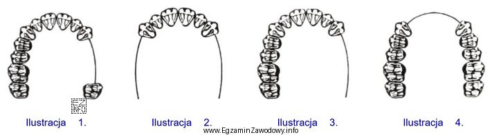Która ilustracja przedstawia schemat III klasy braków zę