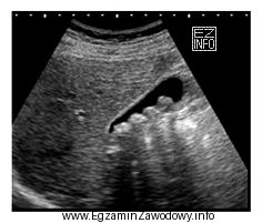 Którą strukturę anatomiczną uwidoczniono na zamieszczonym obrazie USG?