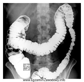Przedstawiony obraz radiologiczny został zarejestrowany podczas badania jelita