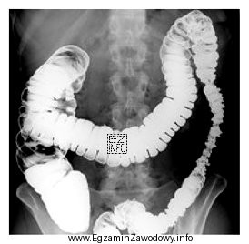 Przedstawiony obraz radiologiczny został zarejestrowany podczas badania jelita