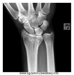 Na obrazie radiologicznym nadgarstka uwidoczniono złamanie nasady