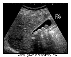 Którą strukturę anatomiczną uwidoczniono na zamieszczonym obrazie USG?