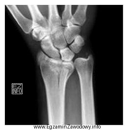 Na obrazie radiologicznym nadgarstka uwidoczniono złamanie nasady