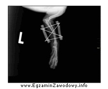 Na rentgenogramie widoczne jest zespolenie po złamaniu kości