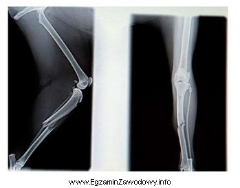 Na zdjęciu rentgenowskim przedstawiono złamanie kości