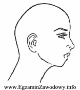 Jaka deformacja w budowie profilu twarzy jest przedstawiona na rysunku?
