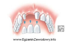 Jaką pracę protetyczną przedstawia rysunek?