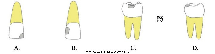 Który rysunek przedstawia ubytek próchnicowy klasy IV?
