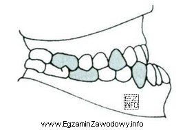 Rysunek przedstawia warunki zgryzowe u pacjenta. Widocznym zaburzeniem zgryzowym jest