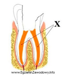 Który materiał endodontyczny stosowany w leczeniukanałowym zęba 