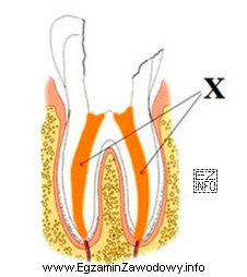 Który materiał endodontyczny stosowany w leczeniukanałowym zęba 