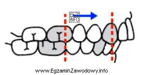 Którą wadę szczękowo-zgryzową przedstawia rysunek?