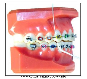 Na ilustracji przedstawiono jeden ze sposobów oczyszczania aparatu ortodontycznego. 