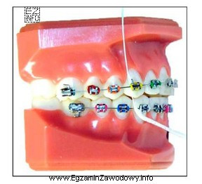 Na ilustracji przedstawiono jeden ze sposobów oczyszczania aparatu ortodontycznego. 