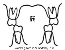 Którą wadę zgryzu przedstawia rysunek?