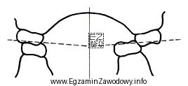 Którą wadę zgryzu przedstawia rysunek?