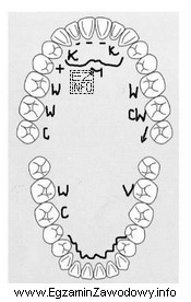 Zamieszczony diagram badania wewnątrzustnego przedstawia