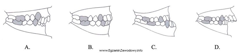 Na którym diagramie zębowym oznaczono próchnicę wtó