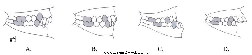 Na którym diagramie zębowym oznaczono próchnicę wtó