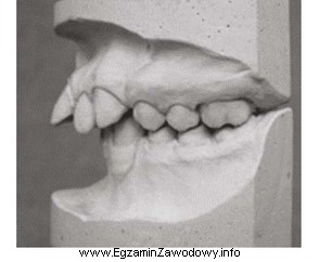 Którą wadę ortodontyczną, według Orlik-Grzybowskiej, przedstawia rysunek?