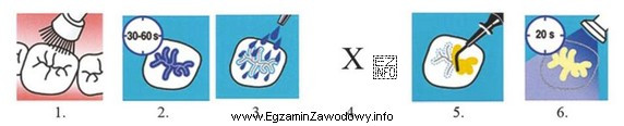 Która czynność wykonywana podczas zabiegu lakowania zębów 