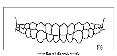 Na rysunku przedstawiono zgryz krzyżowy częściowy