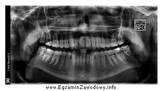 Określ rodzaj zamieszczonego zdjęcia rentgenowskiego.