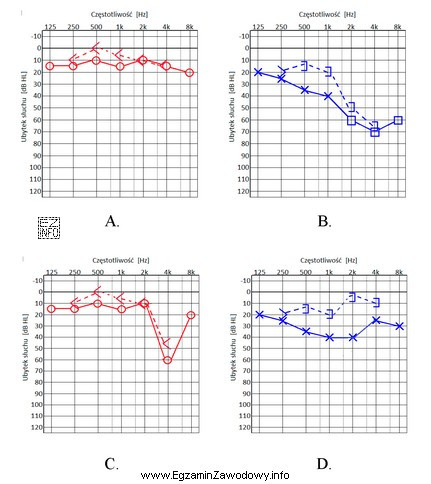 Który audiogram jest charakterystyczny dla urazu akustycznego?