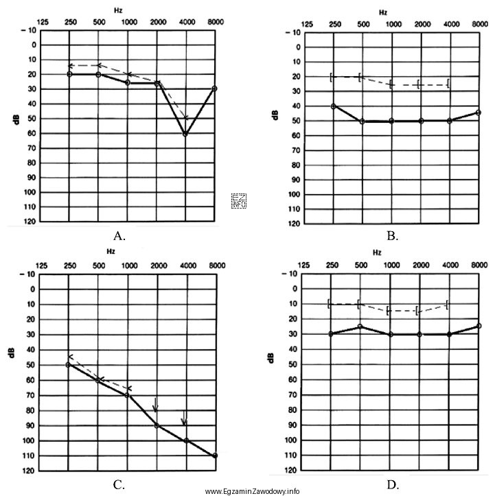 Który audiogram dotyczy pohałasowego ubytku słuchu?