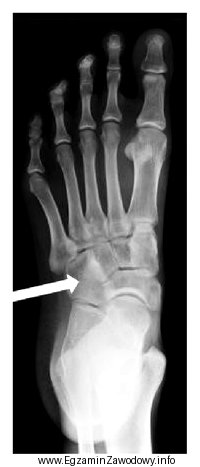 Którą kość zaznaczono strzałką na radiogramie stopy?