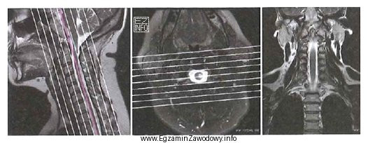 Obrazy MR kręgosłupa szyjnego przedstawiają etap planowania badania 