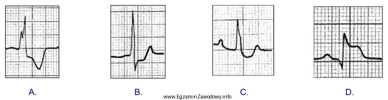 Który zapis EKG przedstawia falę Pardeego?