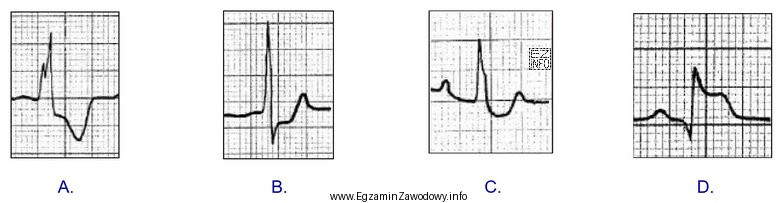 Który zapis EKG przedstawia falę Pardeego?