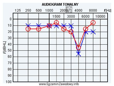 Wynik badania słuchu metodą audiometrii tonalnej wskazuje na