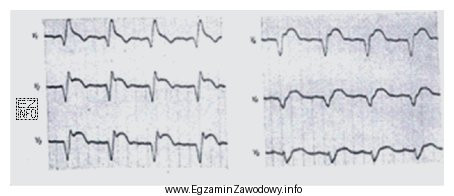 Na elektrokardiogramie zarejestrowano