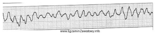 Zamieszczony elektrokardiogram przedstawia