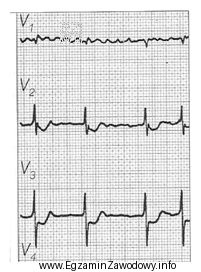Zamieszczony elektrokardiogram przedstawia