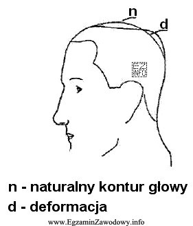 Jaką deformację głowy przedstawiono na rysunku?