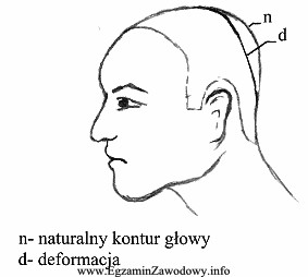 Jaką deformację głowy przedstawiono na rysunku?