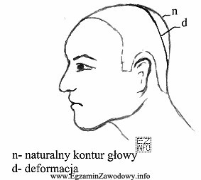 Jaką deformację głowy przedstawiono na rysunku?